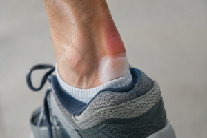 Maladie de Haglund : quand le talon frotte dans la chaussure